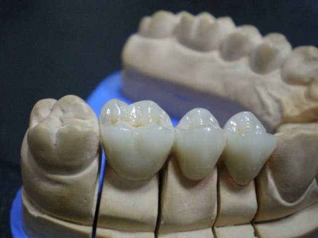 Restauración Fija Dental Trabajo Tradicional De Principio a Fin en Laboratorio Dental Corona y Puente