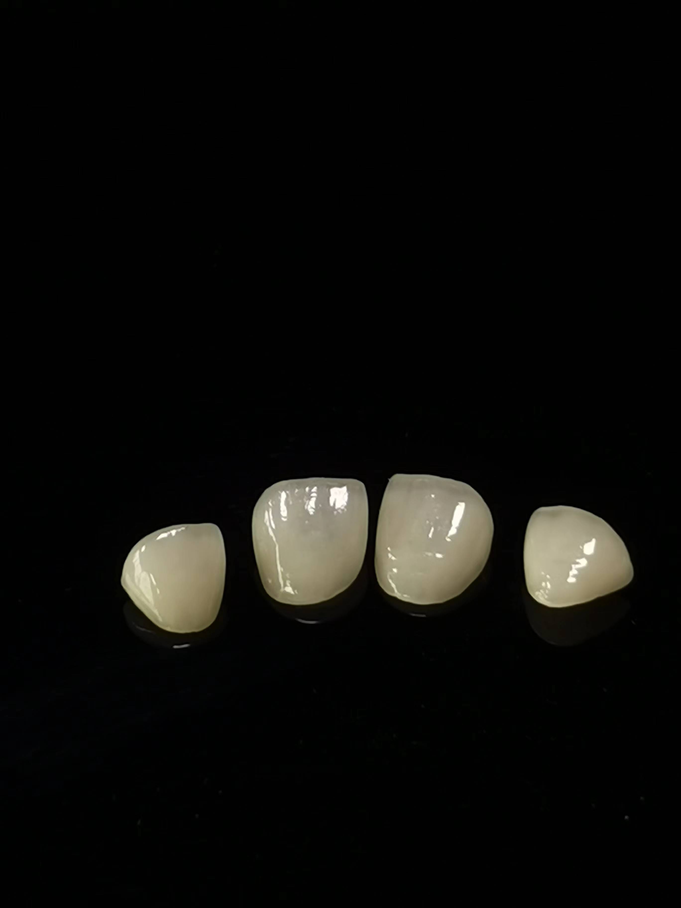 Trabajo de laboratorio dental E.max
