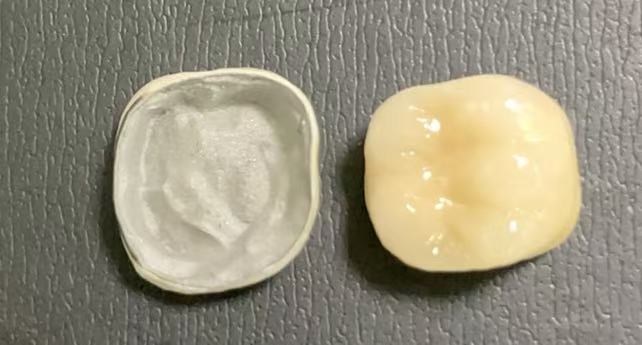 ¿Qué condiciones se requieren para obtener coronas con fusiones de porcelana a metal?