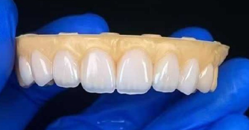 Carillas dentales para reparar el problema de las brechas de los dientes excesivos