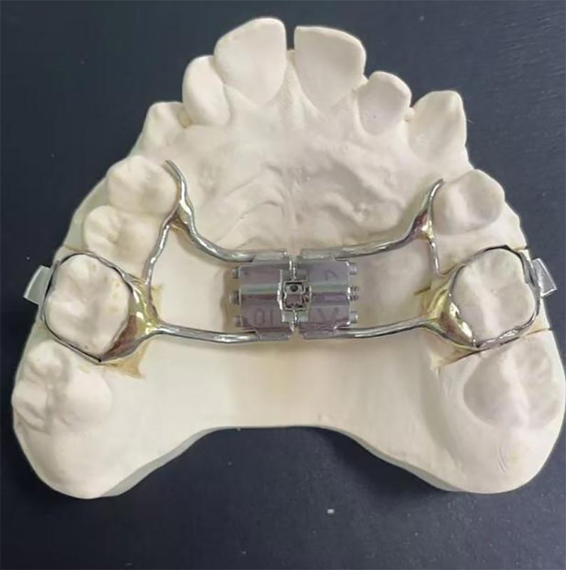 ¿Qué es un expansor maxilar rápido (RME)?