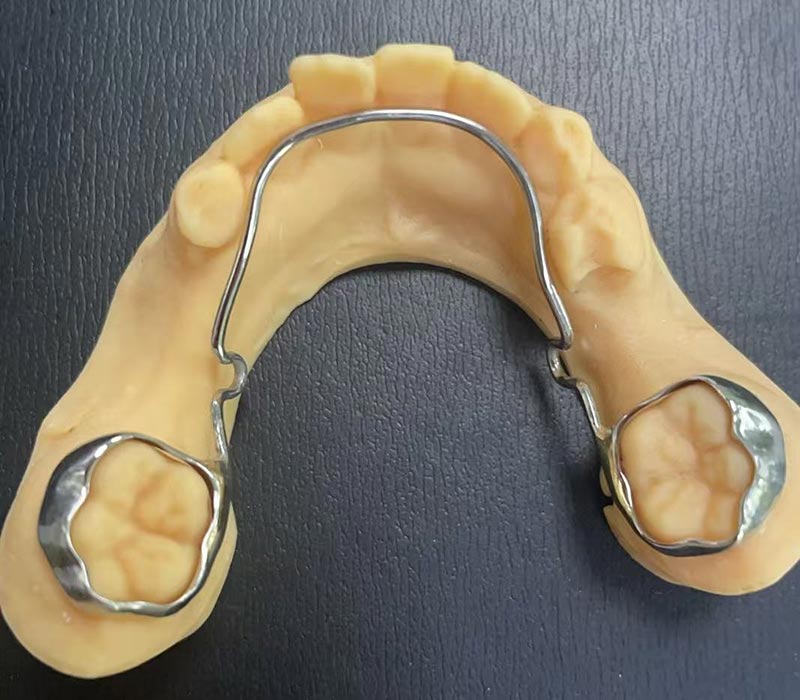 Retenedor del arco lingual mandibular
