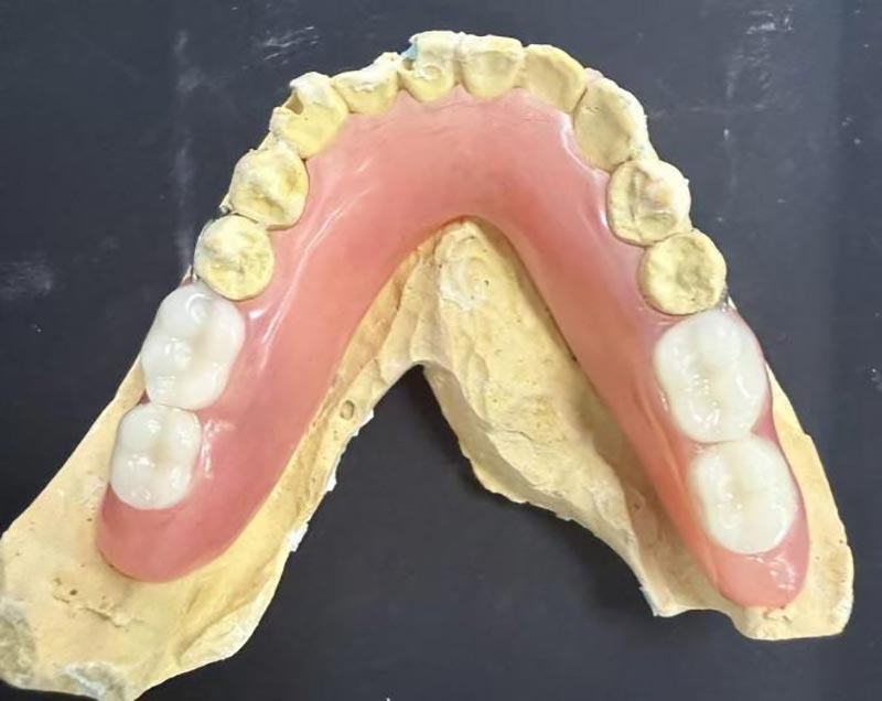 ¿Cuánto tiempo se deben usar las dentaduras postizas parciales? Consejos para usar dentaduras postizas para compartir con las personas mayores