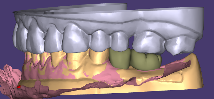 El encerado estético y las restauraciones provisionales de WM Dental Lab obtienen el reconocimiento unánime de los clientes