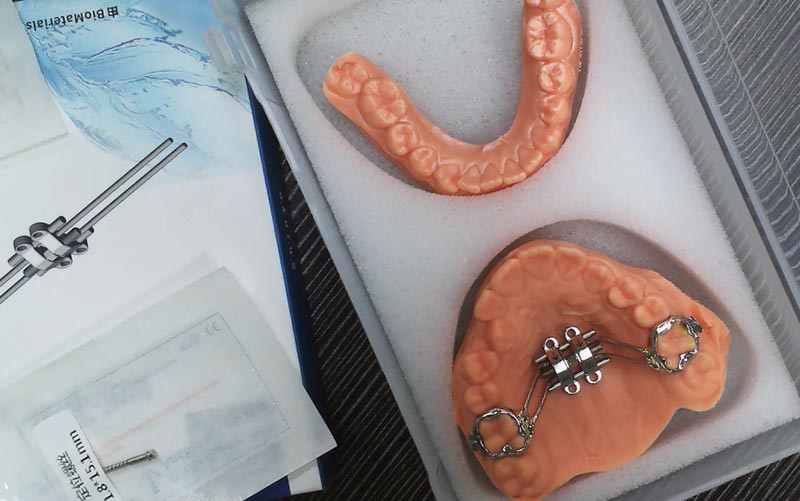 Comprenda la expansión esquelética de MSE con WM Dental Lab