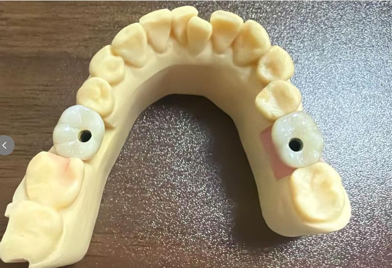 ¿Por qué la implantación de los dientes anteriores es más difícil que la implantación de los dientes posteriores?