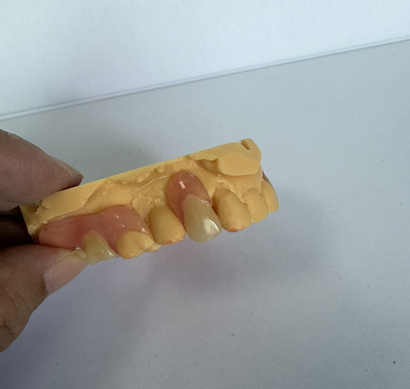 Parciales de Valplast en WM Dental Lab