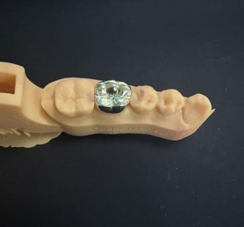 Dientes de oro versus dientes NPG