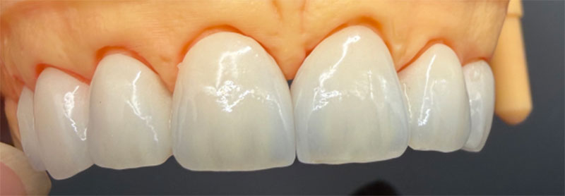 Impacto de los dientes no vitales en las coronas totalmente cerámicas y los tratamientos correspondientes