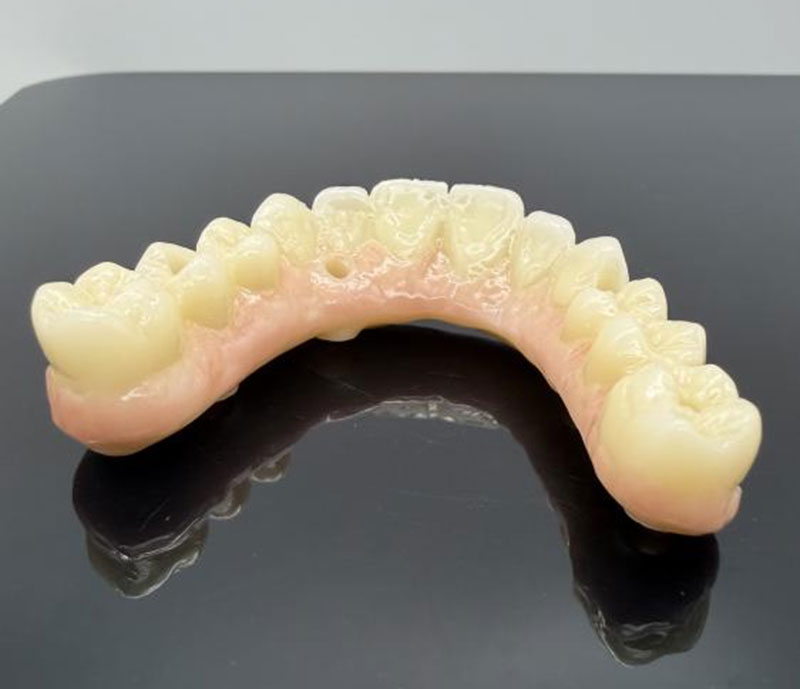 Materiales comunes para coronas y puentes dentales