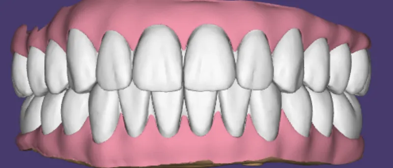 Diseño para dentaduras postizas removibles