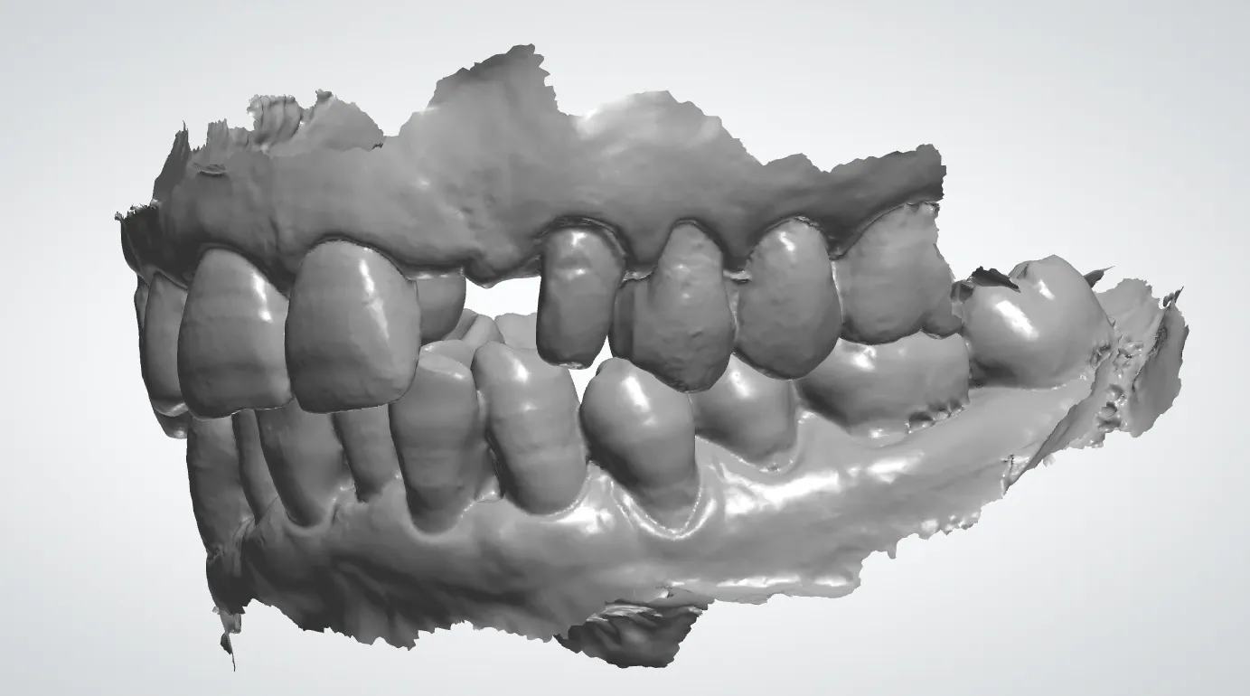 Restaure su sonrisa: soluciones líderes para los dientes perdidos