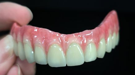 Todo en 4 Hybrid - Malo Bridge Full Zirconia coronas sobre la estructura de titanio