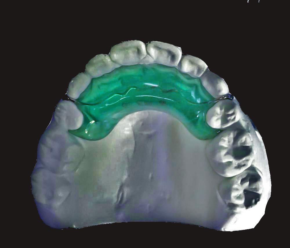 Plano de mordida inclinado anterior