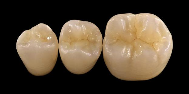 <h2>Zirconia en Odontología: Indicaciones, Ventajas y Consideraciones Clínicas</h2>
<p>La circonita es ampliamente reconocida por su resistencia y durabilidad. Las últimas generaciones de materiales de circonio también ofrecen propiedades estéticas significativamente mejoradas. Para los pacientes que consideran realizar restauraciones totalmente cerámicas, es esencial evaluar cuidadosamente tanto las indicaciones como las limitaciones de los sistemas basados ​​en circonio.</p>
<p>Los pacientes de hoy esperan cada vez más restauraciones que combinen una excelente estética con un rendimiento funcional completo. La mayoría de los sistemas cerámicos modernos pueden cumplir con estas expectativas, pero el éxito clínico depende en gran medida de la selección adecuada del material, la preparación de los dientes y los protocolos de cementación. La elección debe guiarse por las propiedades clave del material, como la resistencia a la fractura, la resistencia a la flexión, la resistencia al desgaste y la estabilidad a largo plazo. Entre estos materiales, el circonio se ha convertido en una de las opciones más utilizadas en la odontología restauradora contemporánea.</p>
<h3>¿Por qué elegir circonita?</h3>
<p>La circona se valora por su resistencia excepcional y durabilidad a largo plazo. La circona moderna se diferencia significativamente de las generaciones anteriores, que eran más opacas y menos estéticas. Hoy en día, la tecnología CAD/CAM permite la fabricación precisa de restauraciones de circonio con propiedades ópticas mejoradas.</p>
<p>Las restauraciones se pueden diseñar como:</p>
<ul>
<li><strong>Circonita monolítica:</strong>Ideal para coronas y puentes posteriores, ofreciendo alta resistencia y durabilidad.</li>
<li><strong>Circonita en capas:</strong>Adecuado para casos que requieren una estética mejorada, incluidas restauraciones de larga duración en diferentes áreas de la boca.</li>
</ul>
<p>La resistencia a la flexión varía según el tipo, desde aproximadamente 590 MPa en circonio de alta translucidez hasta 1400 MPa en formas monolíticas. Las restauraciones de circonio se pueden cementar utilizando cementos de resina autoadhesivos o cementos de ionómero de vidrio modificados con resina.</p>
<h3>Factores clave en la selección del material de circonio</h3>
<p>Al considerar el circonio para una restauración totalmente cerámica, los médicos deben evaluar varios factores críticos:</p>
<ul>
<li>Estructura dental restante</li>
<li>Ubicación en la cavidad bucal (zona estética vs zona funcional)</li>
<li>Presencia de hábitos parafuncionales como el bruxismo.</li>
<li>Translucidez de los dientes naturales adyacentes.</li>
<li>Color y condición de la estructura dental subyacente.</li>
</ul>
<p>La zona estética normalmente incluye los dientes anteriores, aunque en algunos pacientes puede extenderse hasta el primer molar dependiendo de la línea de la sonrisa y la dinámica facial. La zona funcional generalmente incluye premolares y molares, donde las fuerzas oclusales son significativamente mayores.</p>
<h3>Aplicaciones de zonas funcionales</h3>
<p>En las regiones posteriores, se deben considerar cuidadosamente las fuerzas oclusales. La circona es una excelente alternativa a las restauraciones tradicionales de PFM, especialmente en casos con espacio de restauración limitado. La circona monolítica moderna permite un diseño de contorno completo de la anatomía oclusal, incluidas cúspides funcionales y crestas marginales, manteniendo al mismo tiempo una alta resistencia.</p>
<p>La evidencia actual muestra que la circona monolítica es muy adecuada para coronas posteriores y puentes múltiples debido a su excelente resistencia a la fractura y al desgaste. Los avances en las técnicas adhesivas y el diseño de preparaciones también han mejorado los resultados clínicos a largo plazo.</p>
<h3>Aplicaciones de zonas estéticas</h3>
<p>En la región anterior, las restauraciones deben replicar fielmente el color, la translucidez y el comportamiento de la luz naturales del diente. Si bien los materiales como el disilicato de litio ofrecen una estética excelente, son menos resistentes y normalmente requieren una unión adhesiva.</p>
<p>Una ventaja clave de la circona es su capacidad para cementarse de forma convencional y al mismo tiempo lograr un alto rendimiento estético. Con el desarrollo de sistemas de circonio multicapa y de alta translucidez, ahora es posible producir restauraciones que imiten fielmente la dentición natural.</p>
<p>Las técnicas de procesamiento avanzadas mejoran aún más las propiedades ópticas y reducen las imperfecciones que pueden afectar la transmisión y la apariencia de la luz.</p>
<h3>Resistencia y estética combinadas</h3>
<p>Los primeros sistemas de circonio priorizaban la resistencia pero carecían de calidad estética. La circona monolítica moderna combina con éxito resistencia y apariencia mejorada, lo que la hace adecuada para una amplia gama de casos clínicos.</p>
<p>Es particularmente beneficioso para pacientes con hábitos parafuncionales o fracasos de restauración previos. Los estudios clínicos indican una alta aceptación por parte de los pacientes y bajas tasas de complicaciones.</p>
<p>Las preocupaciones sobre el desgaste de la dentición antagonista se han reducido con formulaciones más nuevas. Las superficies de circonio altamente pulidas demuestran un bajo potencial abrasivo y, en algunos casos, pueden ser más suaves que las restauraciones tradicionales de porcelana fundida sobre metal.</p>
<h3>Implantes de circonio: alternativa emergente</h3>
<p>Si bien los implantes de titanio siguen siendo el estándar clínico, los implantes de circonio están ganando atención como una alternativa sin metal. Los primeros diseños eran principalmente sistemas de una sola pieza, pero los implantes de circonio de dos piezas ahora permiten una mayor flexibilidad protésica.</p>
<p>Los implantes de circonio son particularmente útiles en casos en los que existen problemas estéticos, como una posible decoloración gris de los tejidos periimplantarios o un biotipo gingival delgado. También se pueden considerar para pacientes con sensibilidad poco común al titanio.</p>
<p>Sin embargo, los implantes de circonio son todavía relativamente nuevos y los datos clínicos a largo plazo siguen siendo limitados en comparación con los sistemas de titanio.</p>
<h3>Conclusión</h3>
<p>La circona ha evolucionado hasta convertirse en un material muy versátil en odontología restauradora, ofreciendo un fuerte equilibrio entre rendimiento mecánico y estética. La selección adecuada de casos y el cumplimiento de los protocolos clínicos son esenciales para lograr resultados óptimos tanto en aplicaciones anteriores como posteriores.</p>